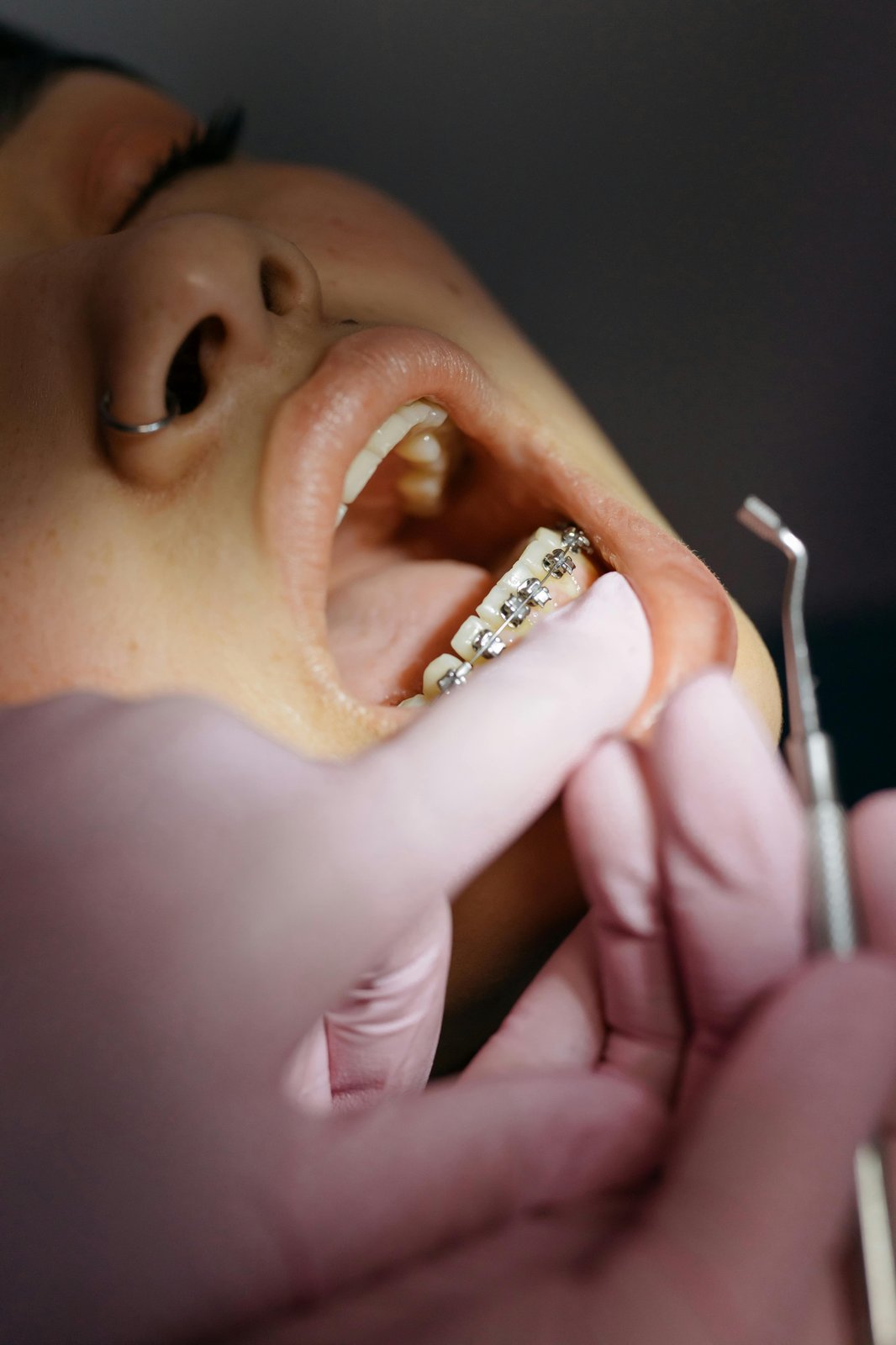 Braces